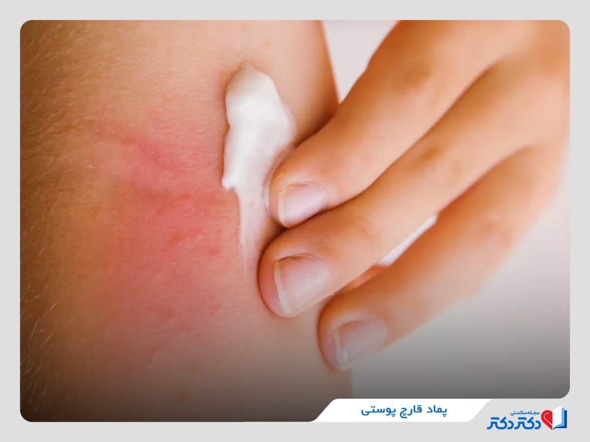 پماد برای رفع قارچ پوستی