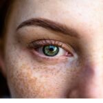 لک‌ های پوستی؛ دلایل ایجاد و جلوگیری