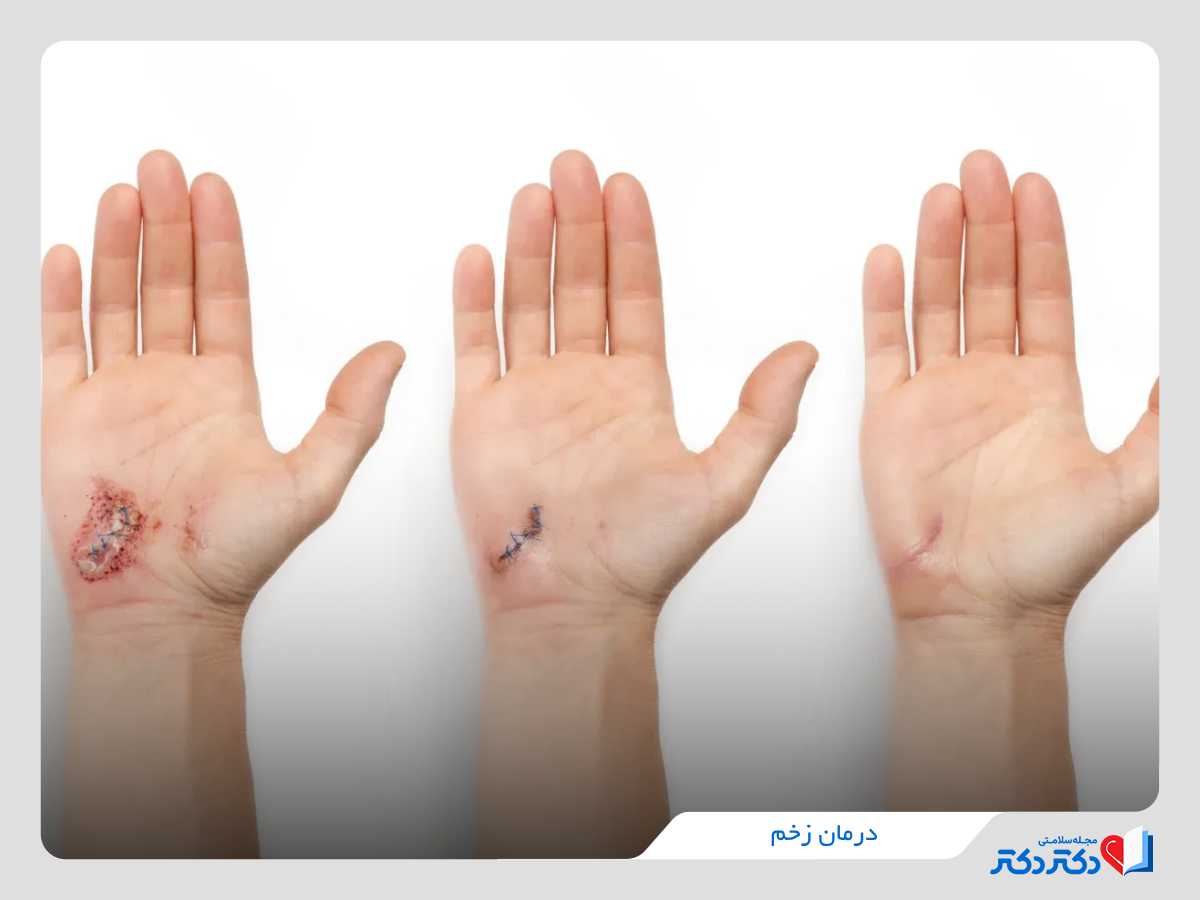 درمان انواع زخم