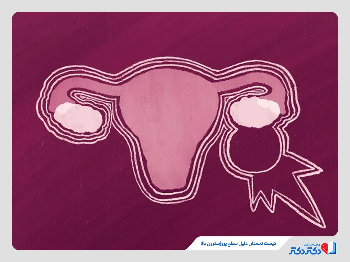 آزمایش پروژسترون زنان راهی برای تشخیص بیماری کیست تخمدان