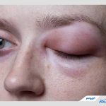 بیماری آنژیوادم چیست؟ راهنمای تشخیص، علل و درمان آنژیوادم