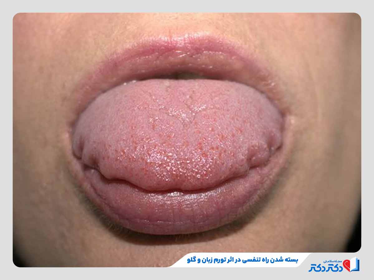 فرد مبتلا به مشکلات تنفسی به دلیل آنژیوادم در ناحیه زبان و گلو