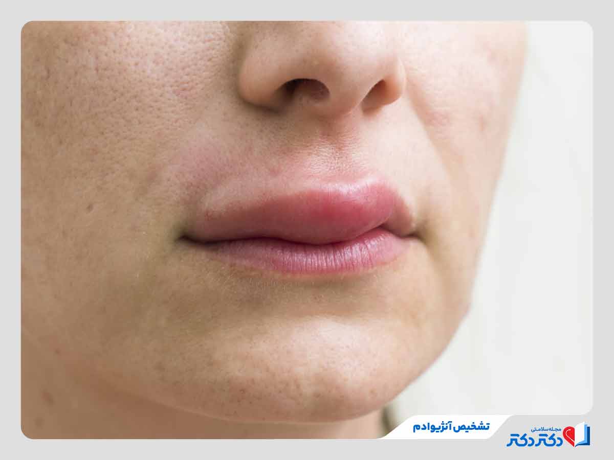 فرد مبتلا به آنژیوادم در ناحیه لب‌ها