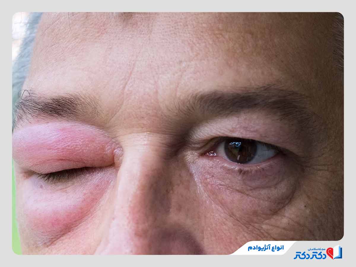 فرد مبتلا به آنژیوادم ارثی از انواع انژیوادم