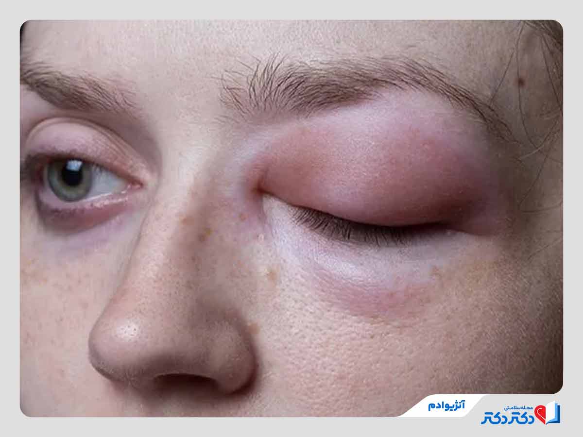تورم در ناحیه پلک به دلیل ابتلا به آنژیوادم