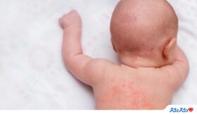 اگزما نوزادان؛ بیماری پوستی شایع که قابل پیشگیری است!
