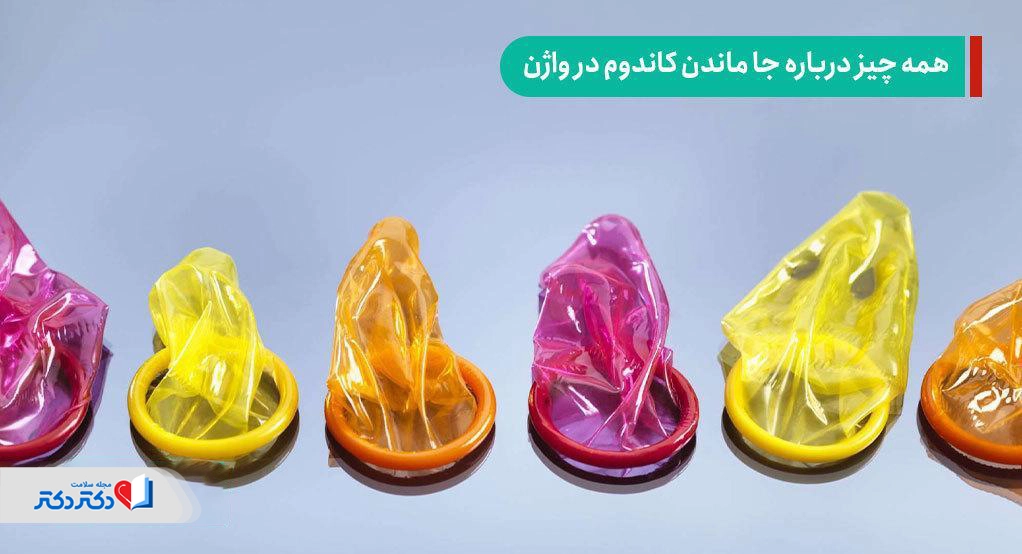 جا ماندن کاندوم در واژن حین رابطه جنسی و نحوه خارج کردن آن
