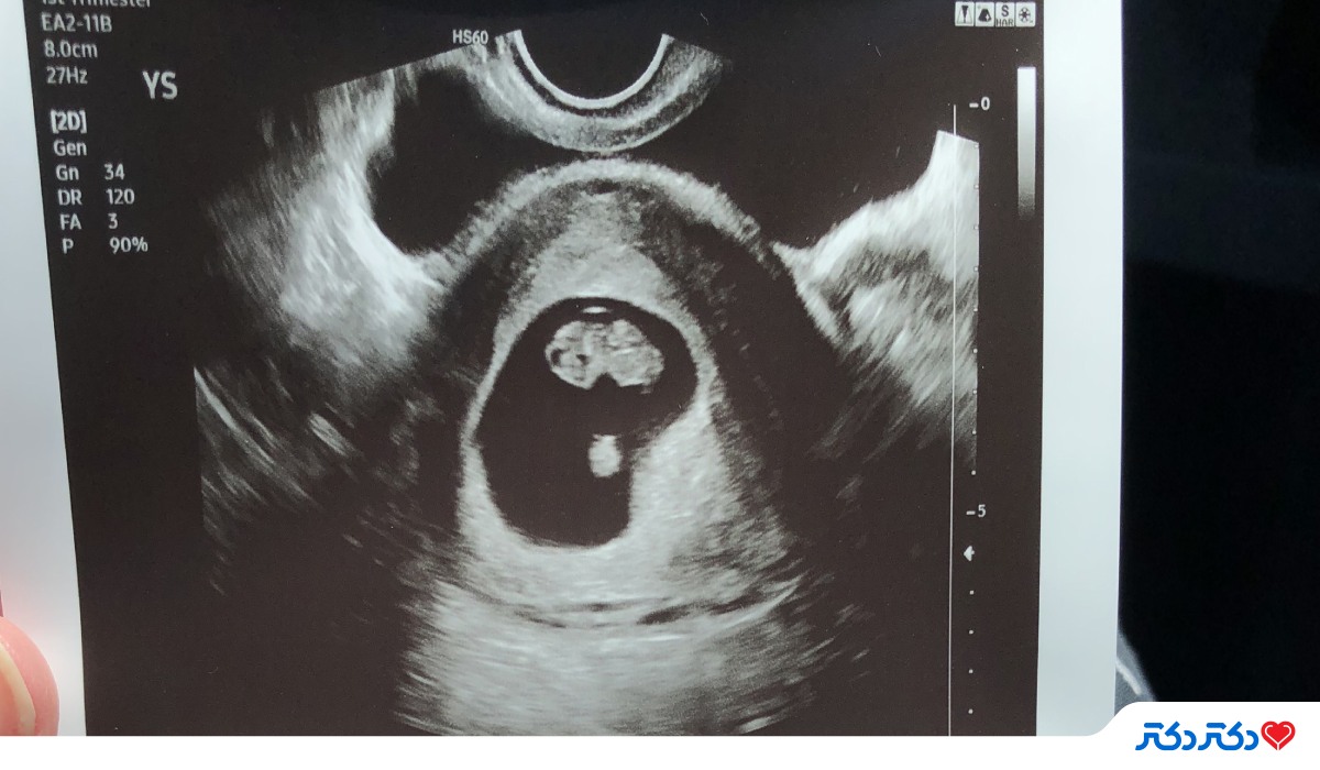 آزمایش سونوگرافی برای تشخیص علت سقط مکرر جنین