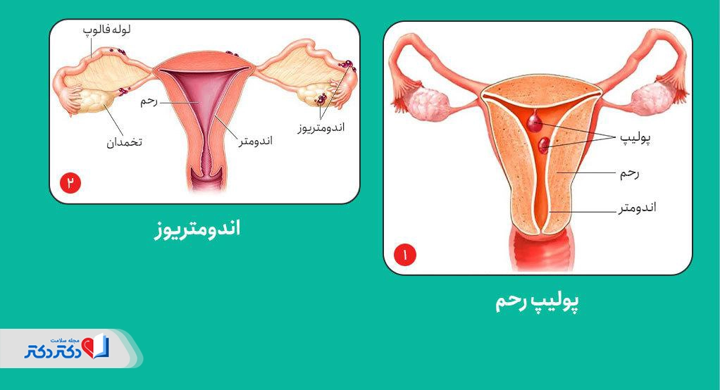 اندومتریوز و پولیپ رحم میتوانند باعث ترشحات غیرطبیعی قهوهای واژن شوند.