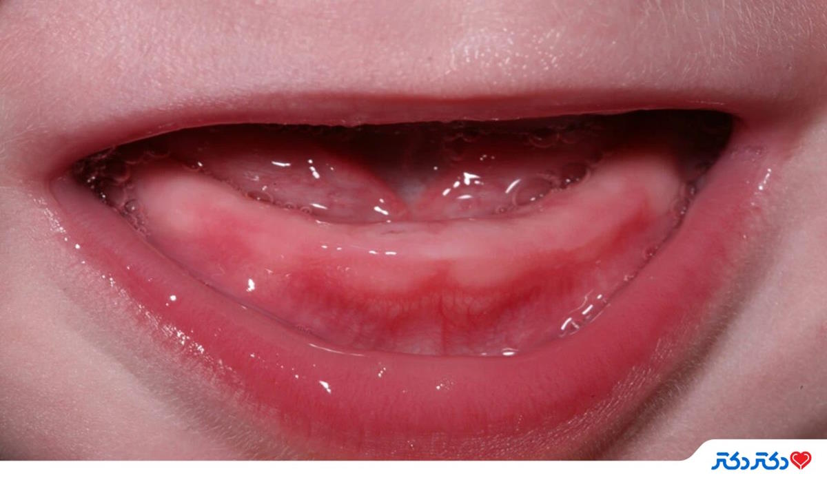 جلوگیری از آبریزش دهان کودک