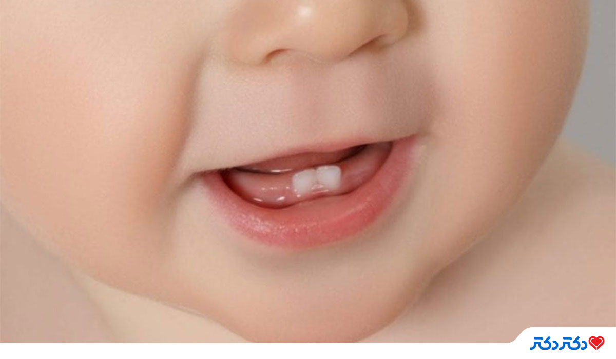ترتیب-رویش-دندان-نوزاد