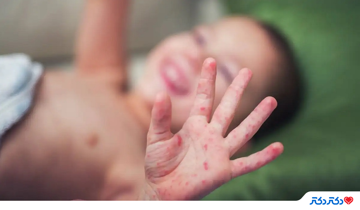 بیماری‌های شایع کودکان و نوزادان عفونت پوستی