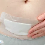 عوارض زایمان سزارین برای مادر و نوزاد؛ خطرات کوتاه و بلندمدت