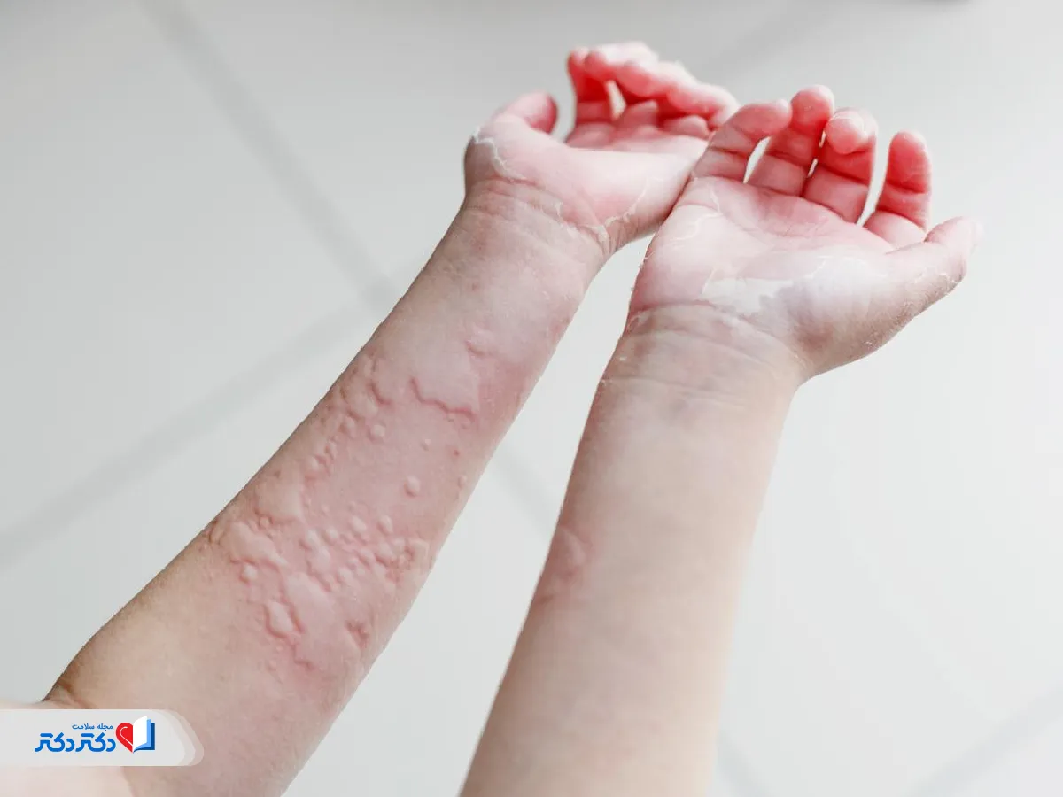 عکس حساسیت پوستی ناشی از کهیر در کودکان