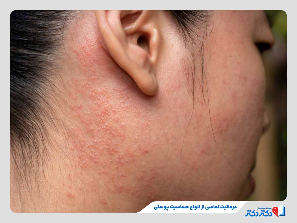 درماتیت تماسی از انواع حساسیت پوستی