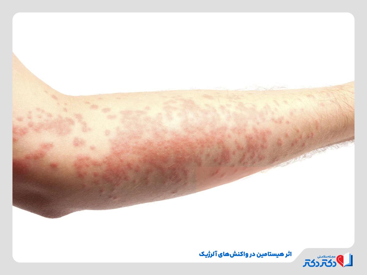 فرد مبتلا به عارضه پوستی به دلیل تولید هیستامین در بدن