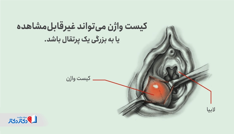 تصوویر کیست واژن و محل بهوجود آمدن آن