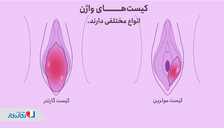 انواع مختلف کیست واژن