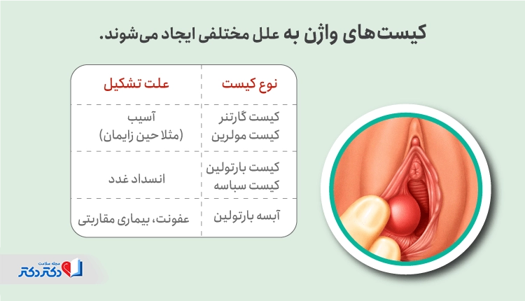 علت کیست واژن