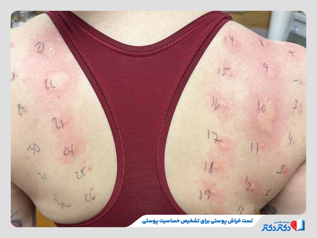 دکتر در حال تشخیص حساسیت پوستی با آزمایش خراش پوستی