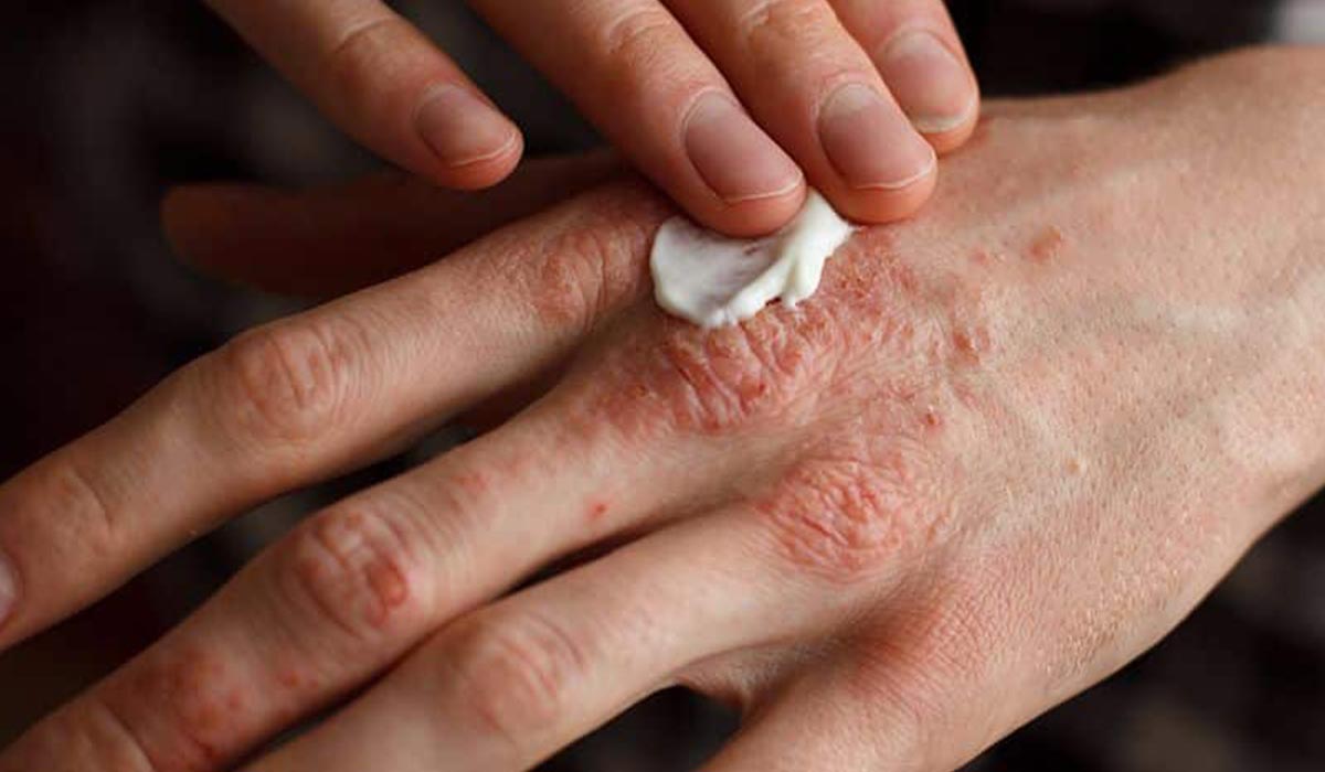درمان اگزما پوستی چیست