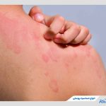 حساسیت پوستی چه انواع، دلایل و درمان‌هایی دارد؟