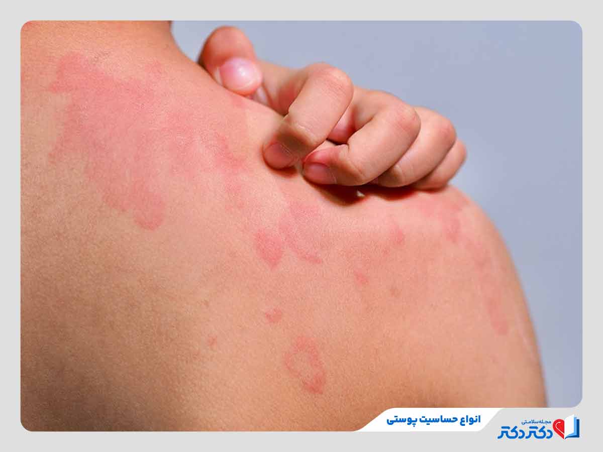 فرد مبتلا به حساسیت پوستی