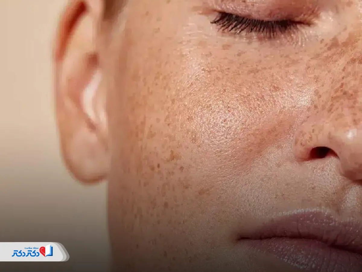 پیشگیری از لکه سیاه روی پوست صورت