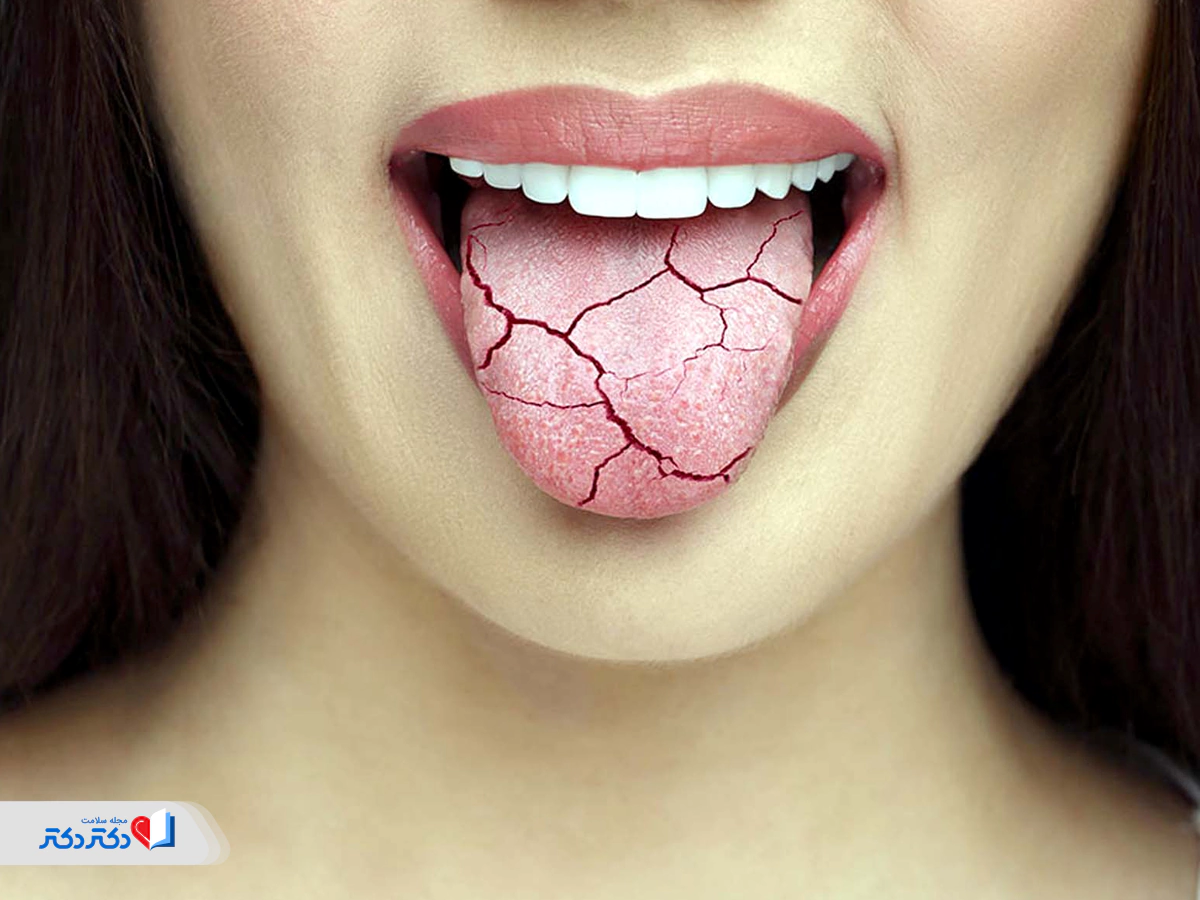 همهچیز درباره علت خشکی دهان