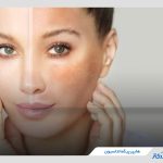 علت لکه‌ سیاه روی پوست چیست؟ بررسی انواع و روش های درمان آن
