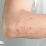 بیماری زونا چیست و چگونه درمان می‌شود؟ (به‌همراه ویدیو)