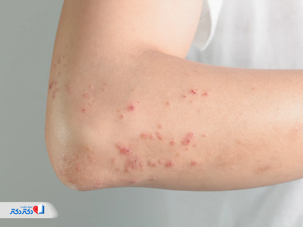 همهچیز درباره بیماری زونا