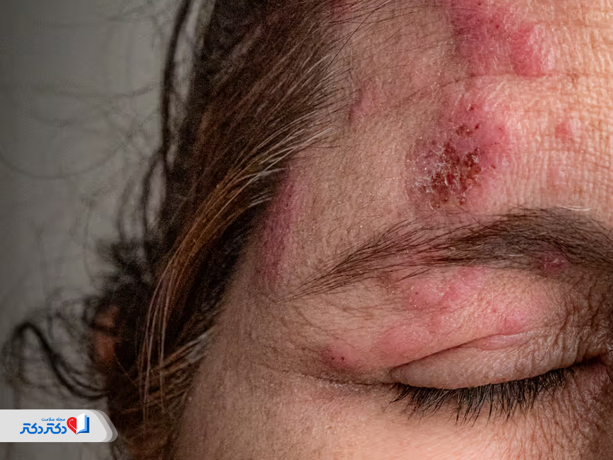 از دست دادن بینایی یکی از ناخوشایندترین عوارض زونا