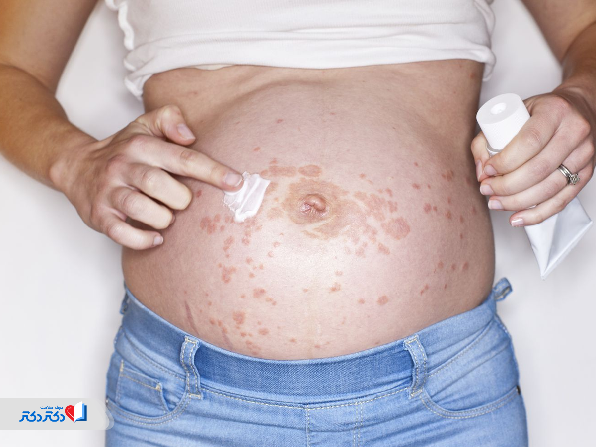 بیماری زونا در دوران بارداری
