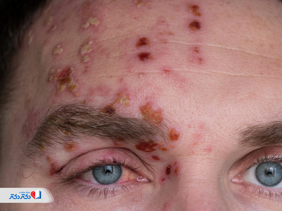 درگیرشدن عصب بینایی از خطرات زونا