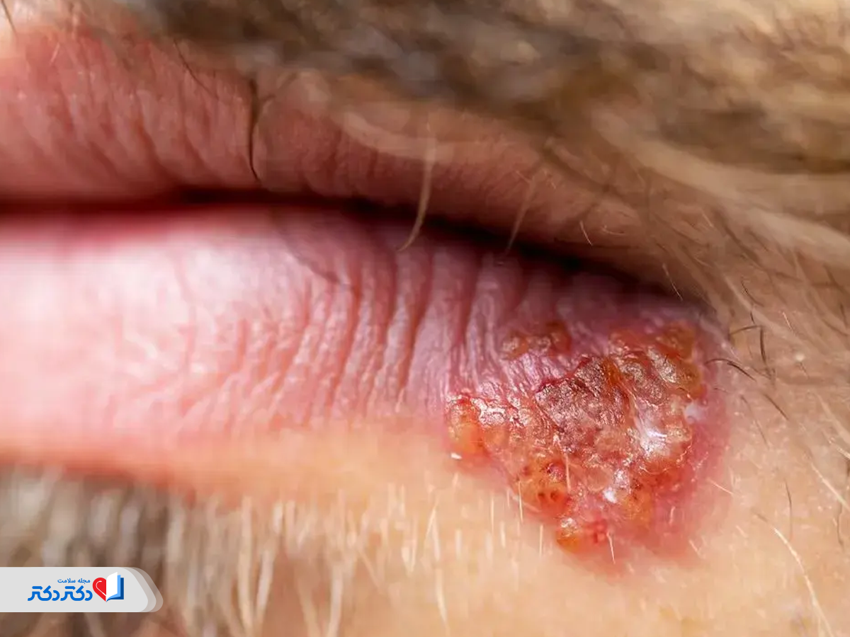 تاولهای خشک و زردرنگ زونا در حال ترمیم