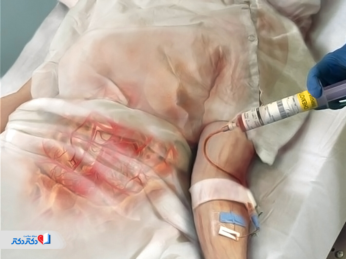 خطر ابتلا به زونا در افراد تحت شیمیدرمانی