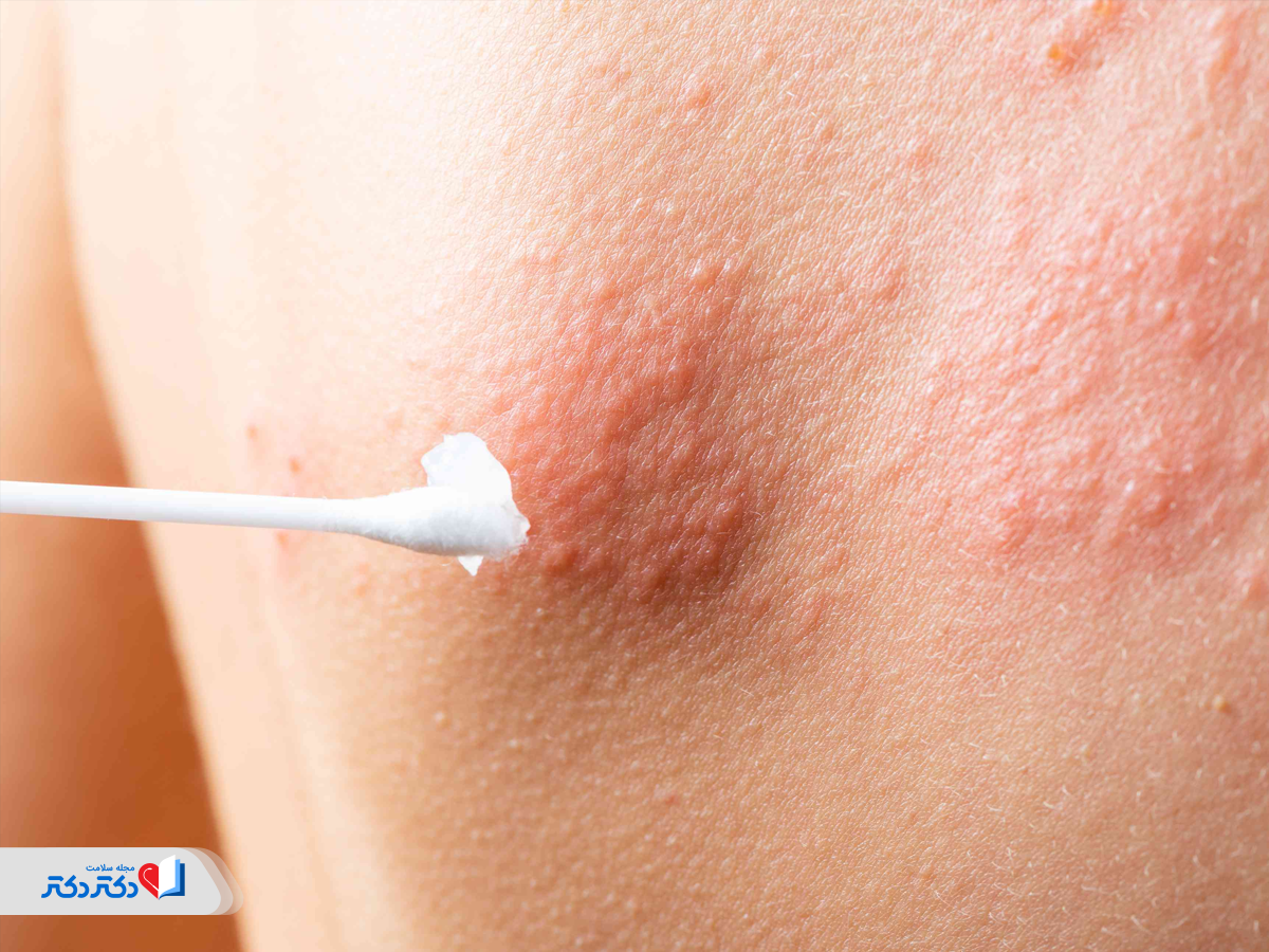 آزمایش نمونه پوست برای تشخیص بیماری زونا