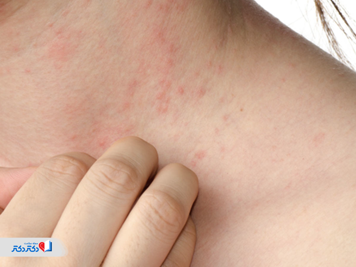 خاراندن محل زخمهای زونا