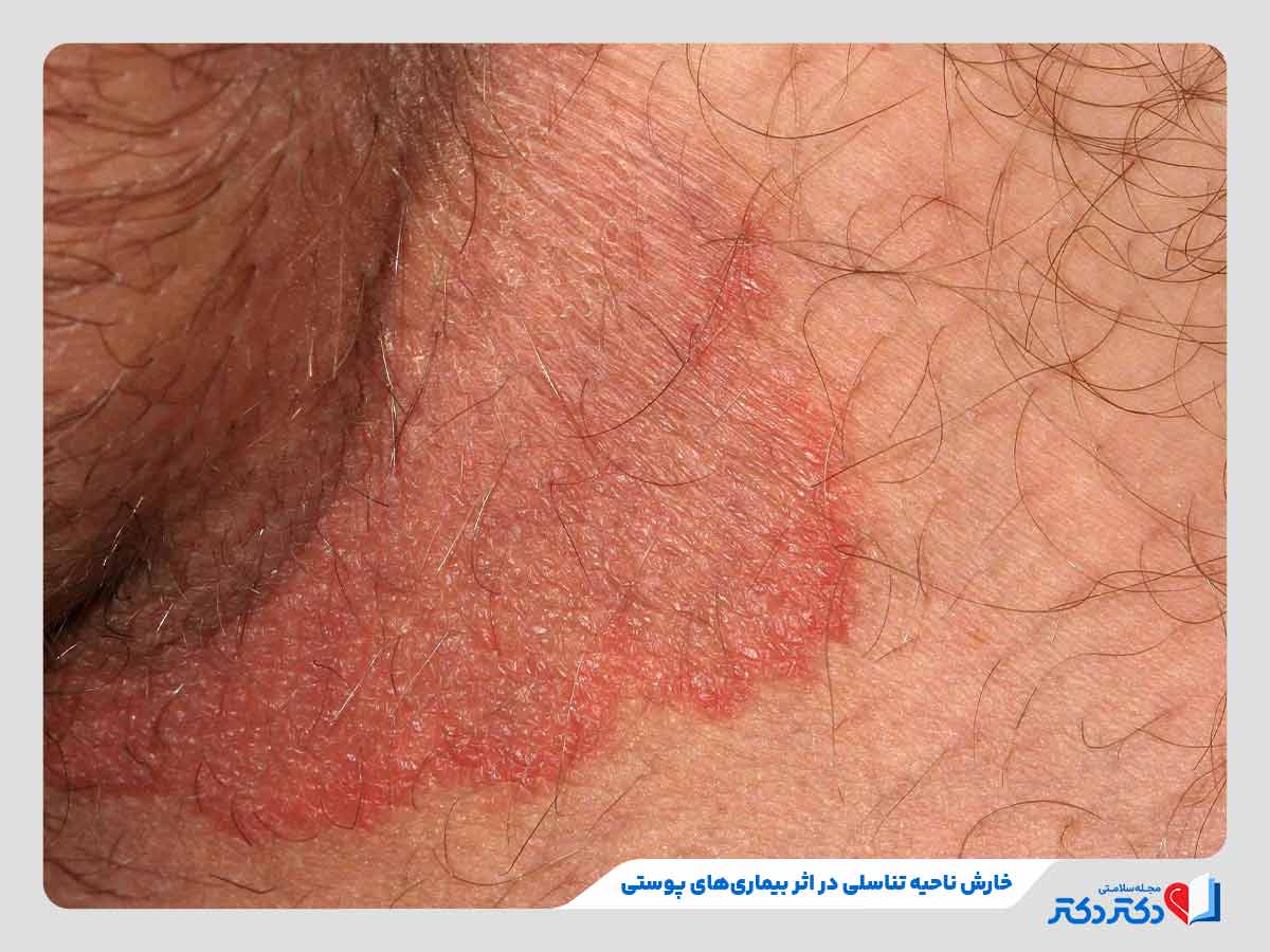 ابتلا به خارش ناحیه تناسلی در مردان و زنان در اثر بیماریهای پوستی