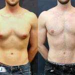 ژنیکوماستی چیست؟ بررسی علت بزرگ شدن سینه در مردان و درمان آن