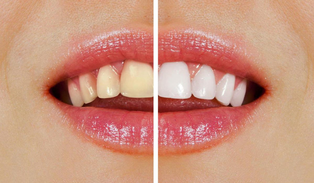 سفیدشدن دندان‌ها