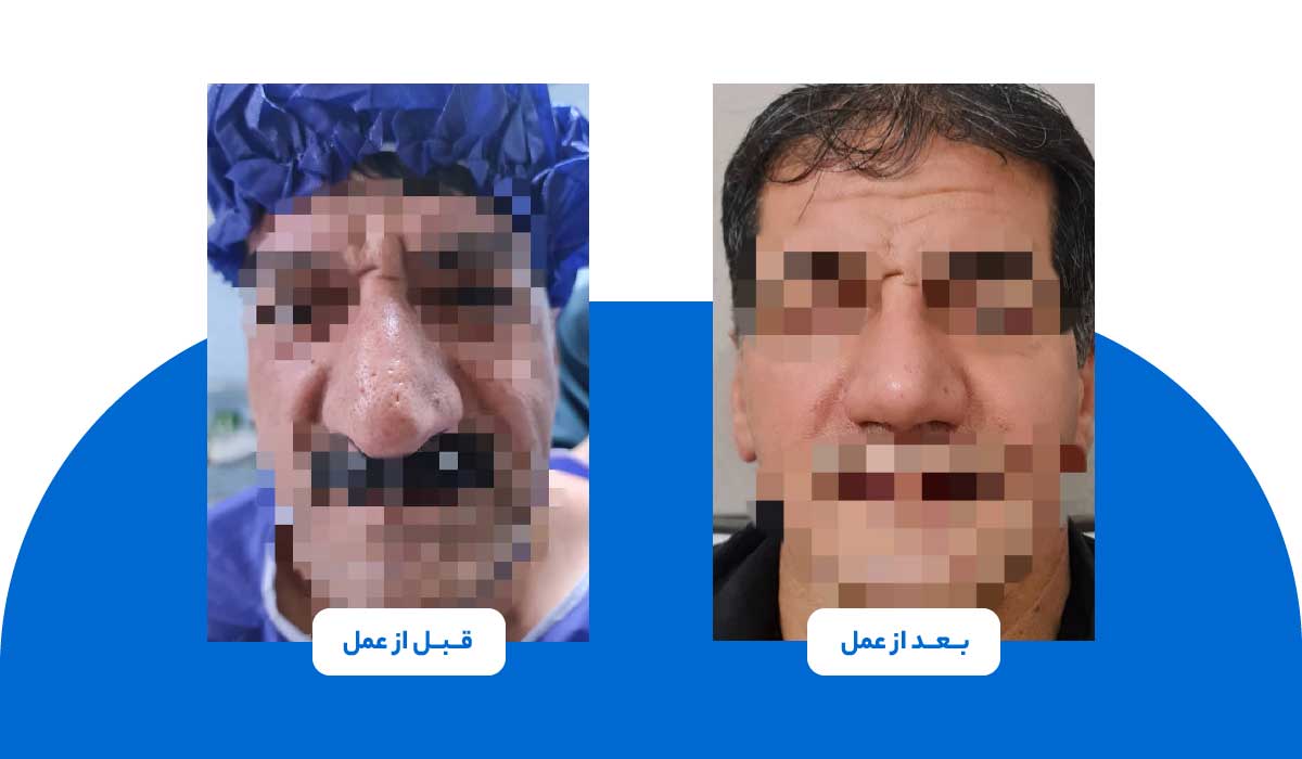 عکس قبل و بعد از عمل بینی گوشتی
