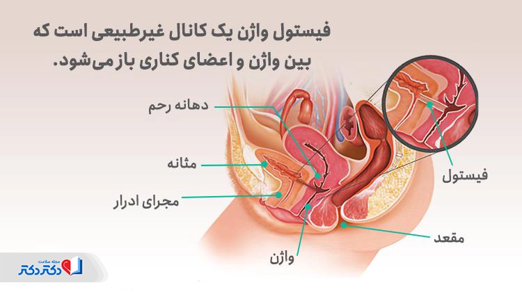 فیستول واژن یک کانال غیرطبیعی است که بین واژن و اعضای کناری باز میشود.