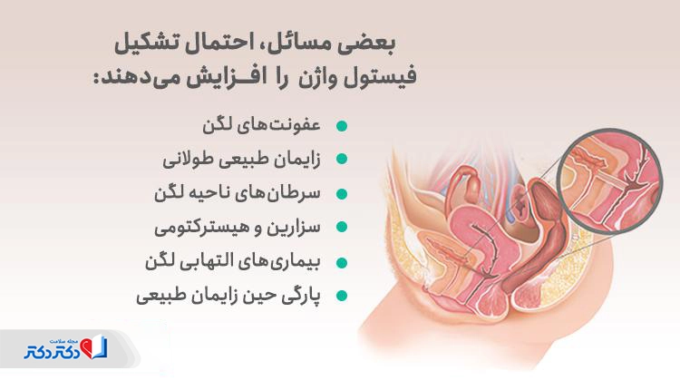 علت فیستول واژن