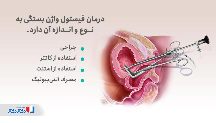 روشهای درمان فیستول واژن