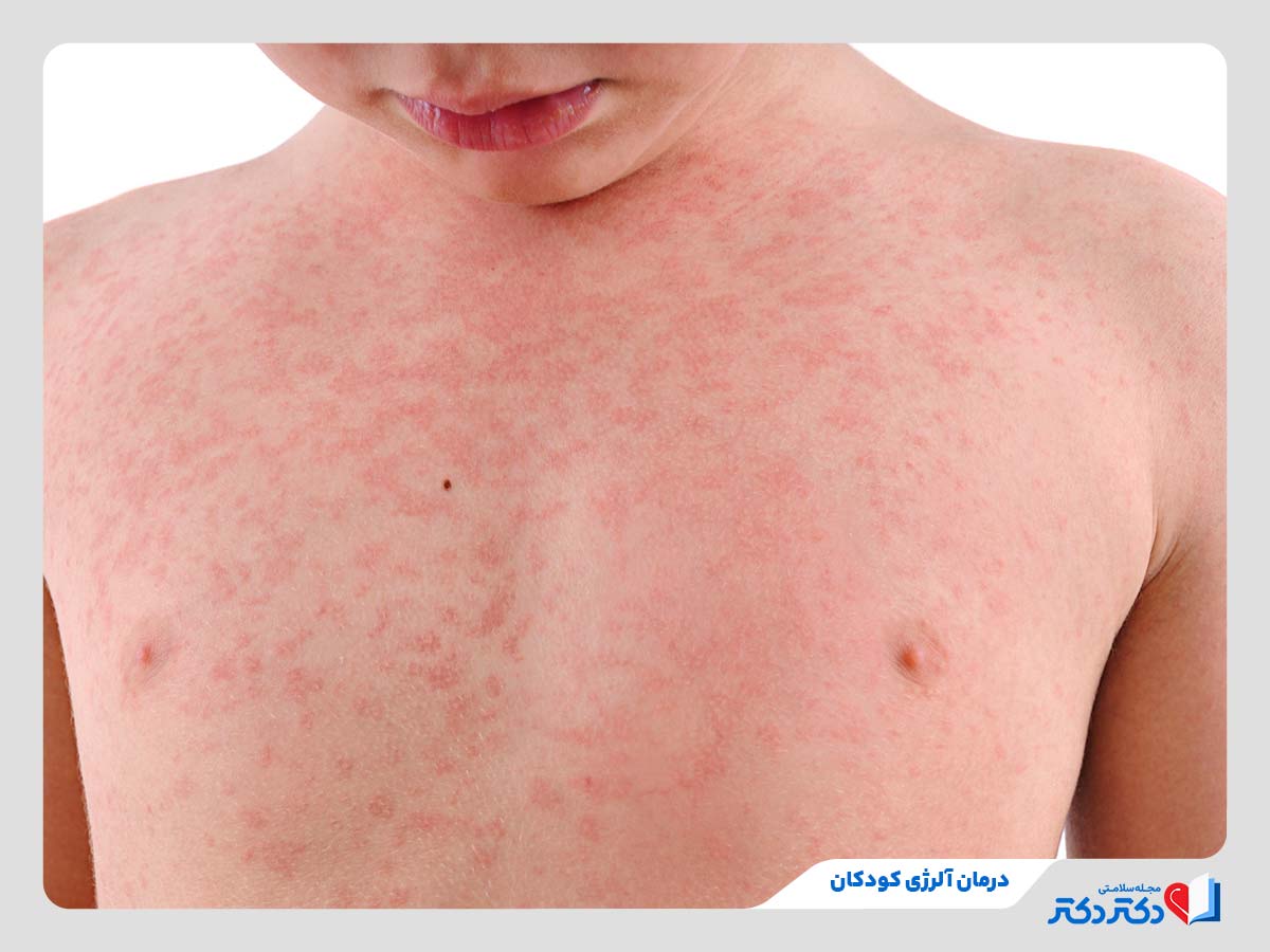 کودک مبتلا به آلرژی پوستی