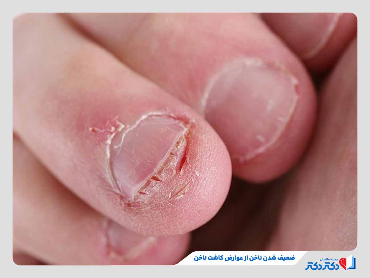 فرد مبتلا به نازک و ضعیف شدن ناخن از عوارض کاشت ناخن