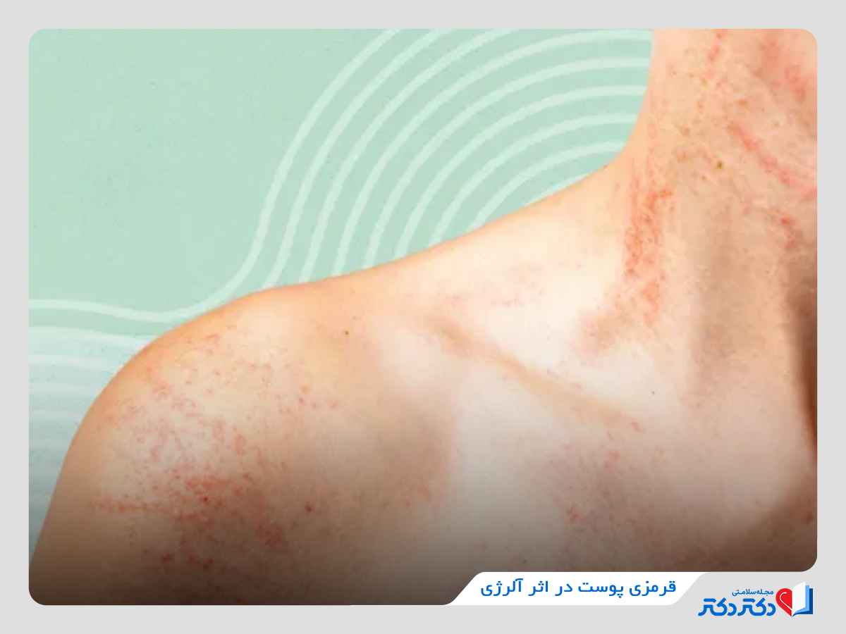 قرمزی پوست در اثر آلرژی