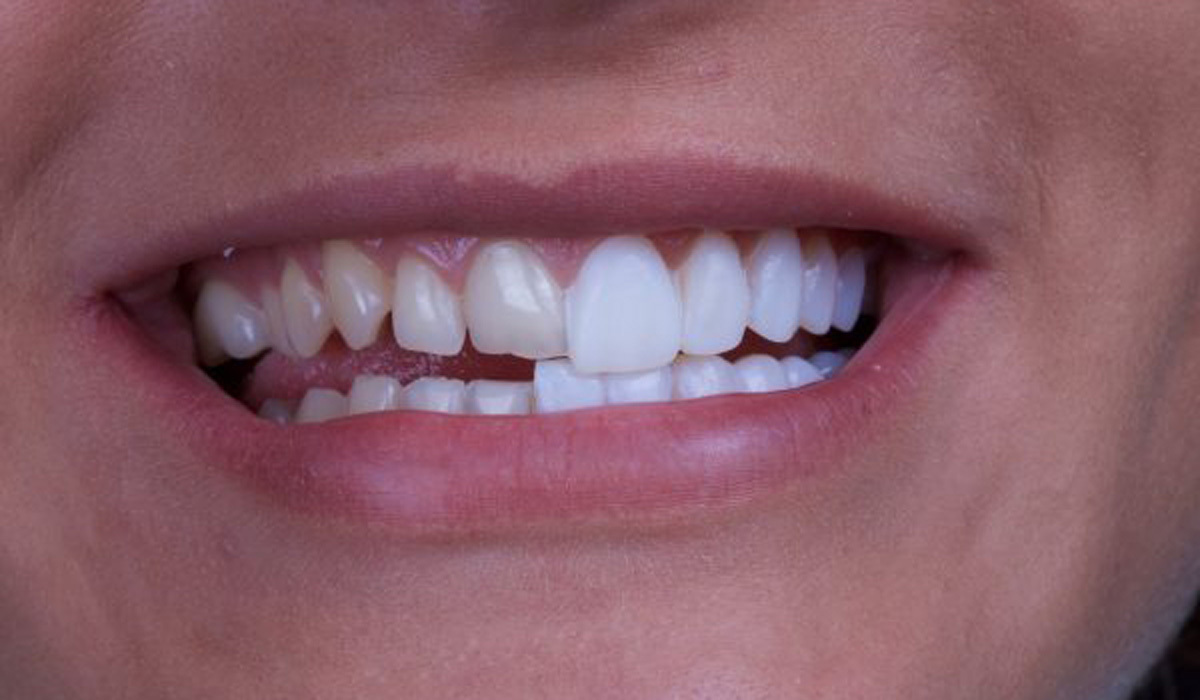 تفاوت میان لمینت و کامپوزیت دندان